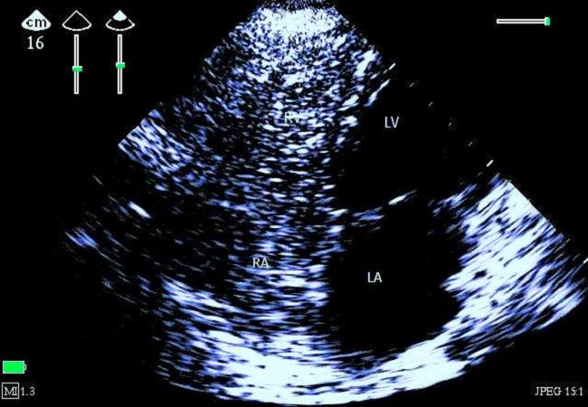 ECHO - obraz masivní plynové embolie ve 4 dutinové apikální projekci Image taken 50 seconds