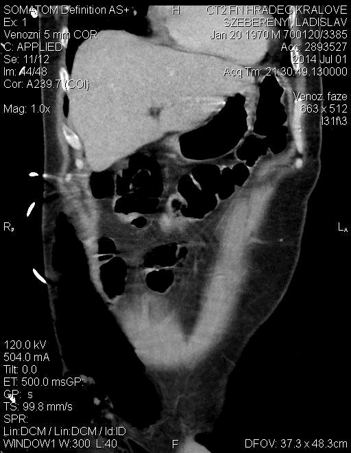 Kontrastní CT břicha obraz