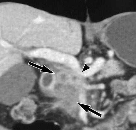 Staging adenoca pankreatu: