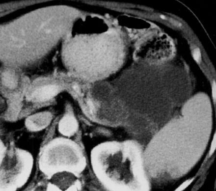 Mucinózní cystický tumor makrocystický mucinózní tumor, syn.