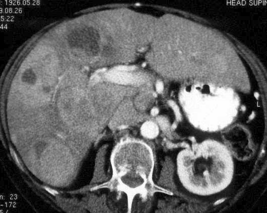 Neuroektodermální tumory afunkční: 15 % obvykle velké, maligní hyperfunkční: 85% především