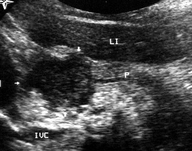 Duktální adenoca 90 % všech nonendokrinních nádorů pankreatu scirrhotický infiltrativní adenoca bohatě buněčný, málo