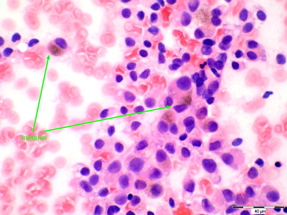 mts maligního melanomu většinou objemné bb.