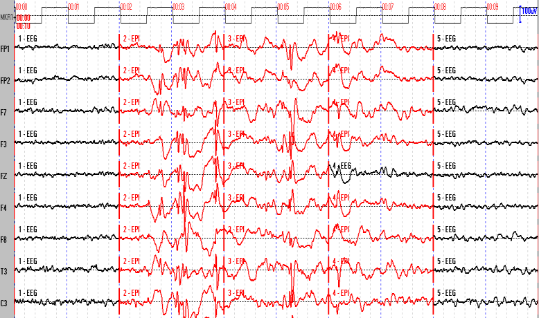 Klasifikace epileptického EEG 4.