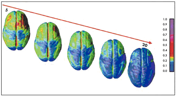 Šedá hmota Obrázek převzatý z Gogtay N. et al. (2004). Dynamické mapování vývoje lidské mozkové kůry během dětství aţ do časné dospělosti. PNAS 101(21), 8174-8179, obr. 3.