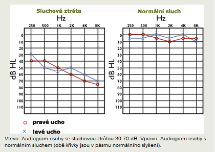 vzdušné vedení, kdy jsou akustické vibrace vysílány cestou bubínku a kůstek středního ucha do ucha vnitřního.