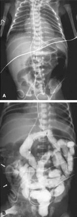 Diagnostika Klinické příznaky střevní obstrukce, historie Rtg - prostý snímek AP, možno horizontální paprsek - snímek s kontrastním nálevem - defekty v plnění UZ Laboratoř- porucha vnitřního