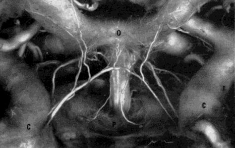 Místo úrazu Hypothalamus Hypofýsa Hypothalamus Pituitary stalk Typ poranění