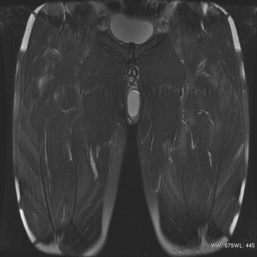 Myositis