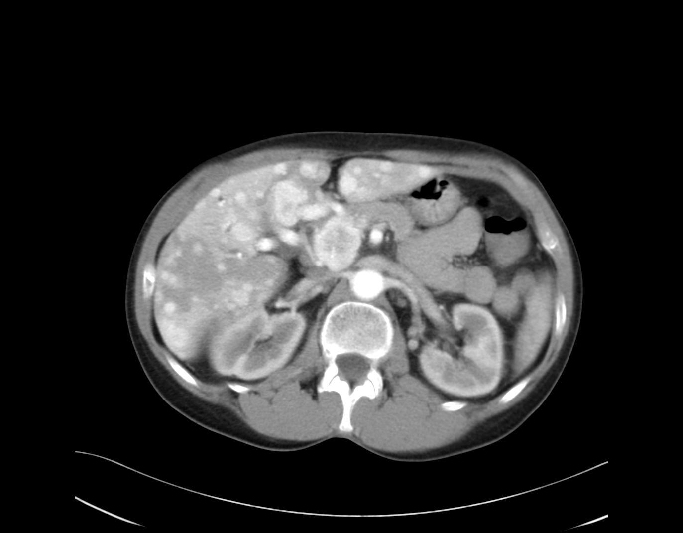 chemoterapii gemcitabinem mírná progrese