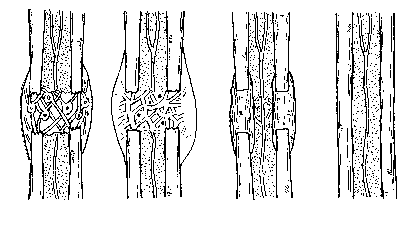 4. Zlomeniny kompresivní (buckle fracture, torus fracture) u těchto zlomenin není kontinuita kosti ani periost porušen, působením násilí dojde ke stlačení v části obvodu kosti a k nahrnutí kortikalis