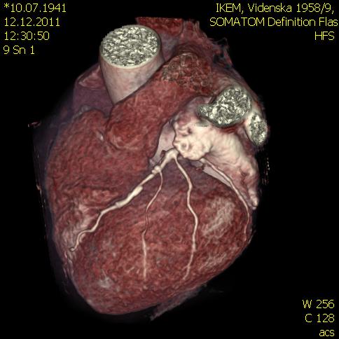 CT koronarografie