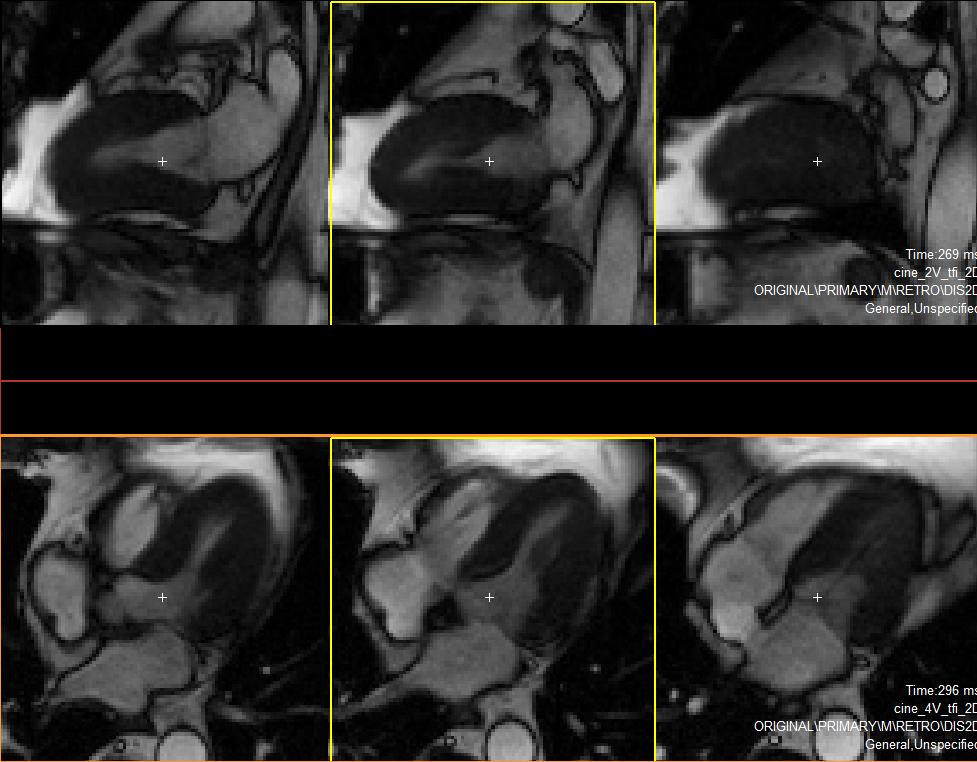 DSMR MRI