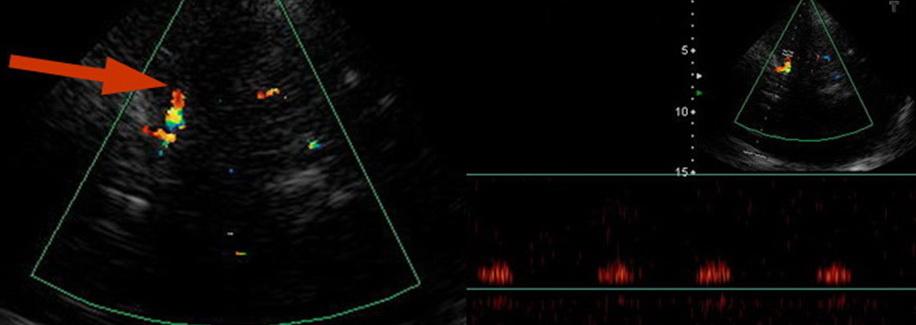 Transkraniální sonografie