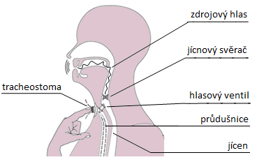 z důvodů oslabení okolní tkáně není provedení tracheoezofageální punkce možné. Tvorba zdrojového hlasu pomocí hlasového ventilu je zobrazena na Obr. 4.