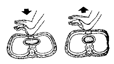 b) postižený v bezvědomí: nehmatný puls, postižený nedýchá - pohyby hrudníku vymizely o ihned zahájíme laickou resuscitaci (oživování) = umělé dýchání + masáž srdce o poměr vdechů ke stiskům hrudníku