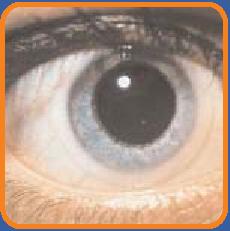 Mikrovaskulární komplikace a účinnost fenofibrátu Diabetická retinopatie (potřeba 1. laserové terapie) 31% p=0.
