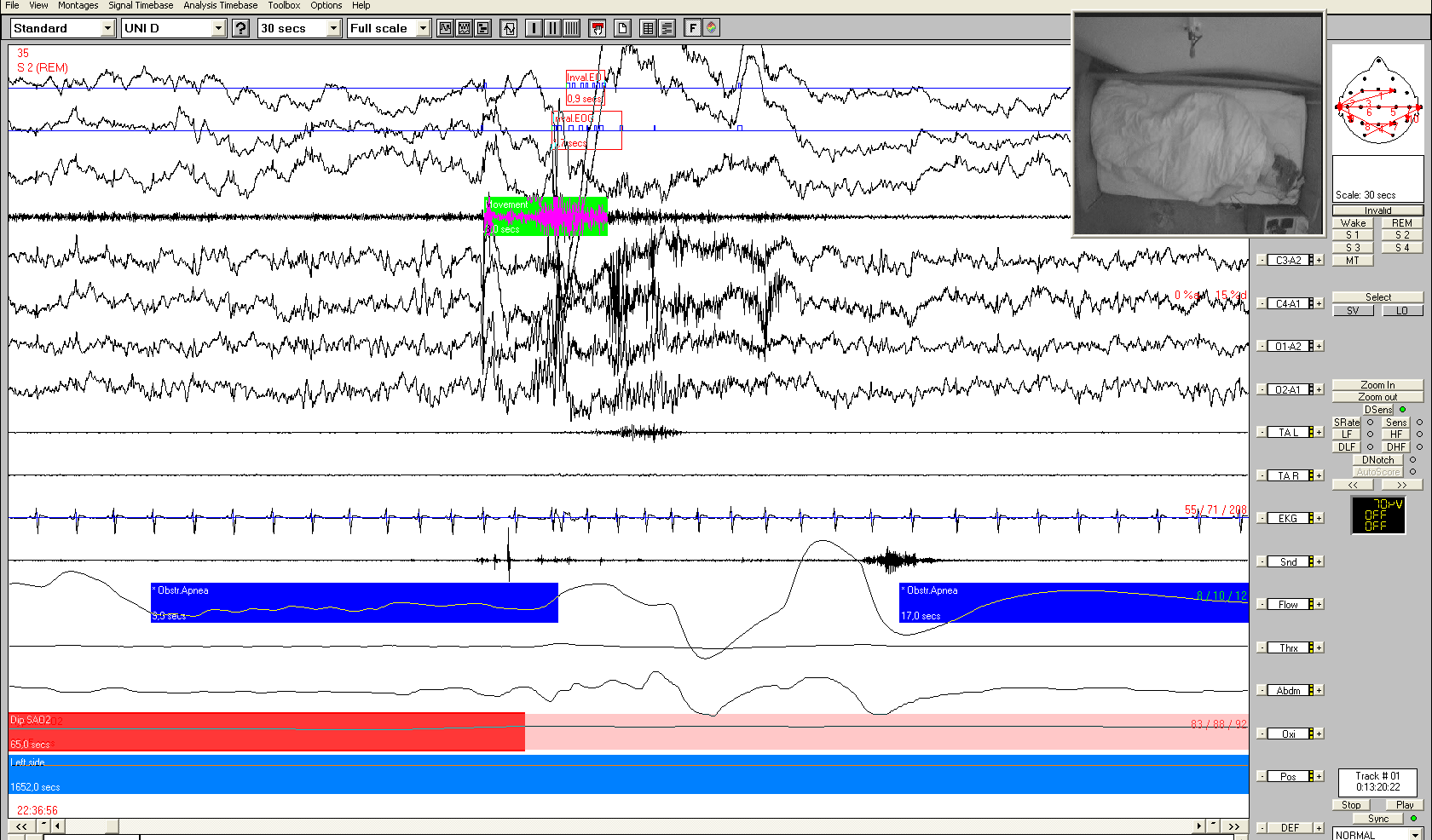 EEG EEG Ment EKG sato 2 Dech Thor Abd Ukončení apnoe probouzecí reakce s