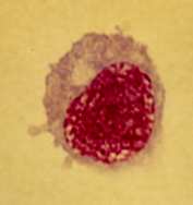 1. Neuroborelióza (1/1) Muž, P.Č., 68 let, hosp. na neurologii Důvod vyšetření: hospitalizace pro bolesti zad, první LP: suspektní aseptická meningitida Sérum: Borrelia sp.