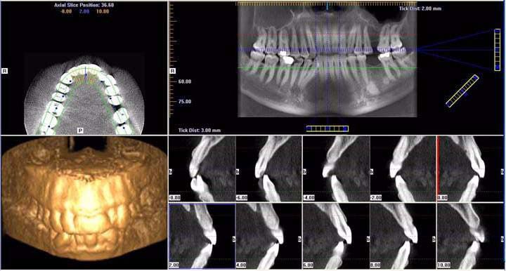 Obrazovka plánování implantátu Dvojím kliknutím na Panoramic View na obrazovce náhledu se zobrazí obrazovka plánování implantátu - Implant Planning Screen.