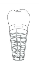 V 60. letech Linkow představil první čepelkový implantát klínovitého tvaru, který se pomalým vklepáváním zaváděl do úzkého kanálku v kosti.