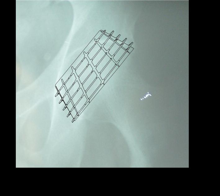 PŘEDOPERAČNÍ PLÁNOVÁNÍ Pro optimální plánování jsou nezbytné předoperační RTG snímky, včetně celkového snímku pánve, předozadního snímku dolní končetiny a laterálního snímku operovaného kyčelního