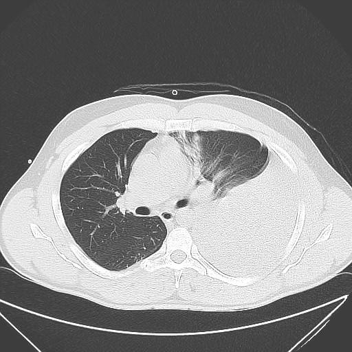 Hemothorax UZ: detekce již 100 ml i méně, odhad množství V (ml) = separace (mm) x 20 odchylka 158 ± 160 ml CT: detekce dalších poranění, výpočet množství V (ml) = 182,6 x b (ml) 139,2 odchylka ± 93,9