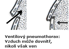 Prvými, projevy plicního nádoru můţe být nechutenství, únavnost, bolesti kloubů, kašel a potivost. Pozdními projevy jsou dušnost, bolesti, dysfagie, zánětlivé komplikace, výpotek a metastazy.