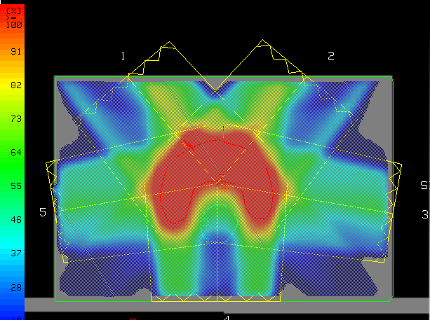 Obrázek 15 Nehomogenní distribuce dávky při IMRT technice 15 Ke zjištení ideálního rozložení dávky se využívá tzv. inverzního plánování.