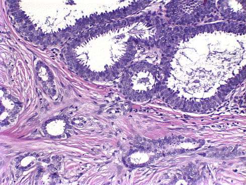 Flat epithelial atypie - FEA FEA častý prekurzor low grade lézí (LG DCIS, LCIS, LG IC NST.