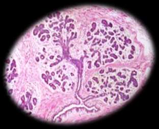 Ukazuje se, že zejména columnar cell léze jsou prekurzorem ADH a low grade DCIS. Nelze opomíjet ani interakci a genetické alterace ve stromálních elementech žlázy, které IPL provázejí.