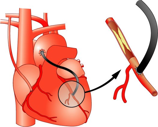 PTCA perkutánní transluminální koronární angioplastika Aotrokoronární by-pass Diagnóza Infarktu myokardu Typický EKG obraz AIM, event. poruchy rytmu. Na echokg.