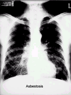 Azbestóza (nezhoubné - benigní) přeměna vlastní plicní tkáně na