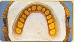 306 - Provrtání spodních části zubů před cpaním plastických hmot Lisy se používají vřetenové nebo hydraulické (obr. 307).