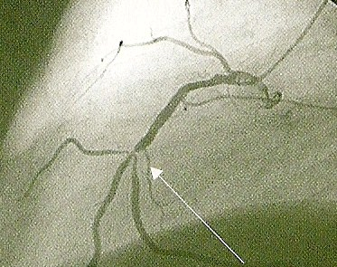 Rovněž je možné na tomto balónku do místa postižení věnčité tepny např. výdutí, dopravit tzv. stent, což je jakási kovová síťka sloužící ke zpevnění postižené oblasti.