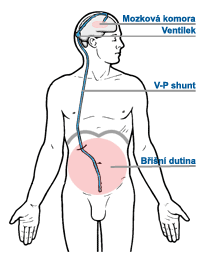 Normotenzní hydrocefalus 1. Klinická trias: porucha rovnováhy a chůze demence inkontinence 2. Zobrazovací metody (CT či MR): komunikující hydrocefalus 3.