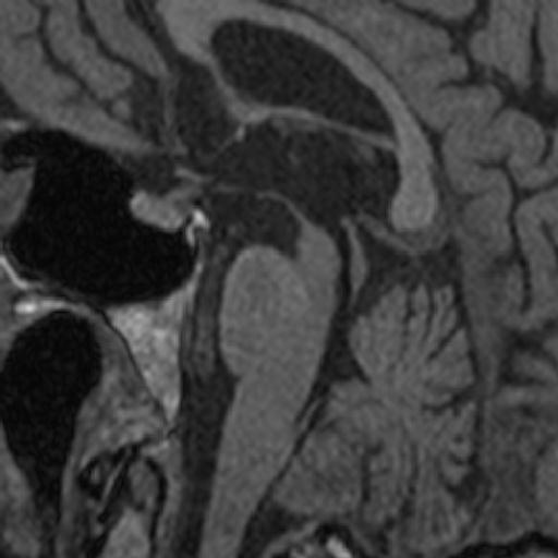 objektivní nález: hypomimie hypofonie mírná hypokineza axiální rigidita kvadrupyramidový syndrom, axiální + instabilita stoje a chůze okohybná porucha vertikální paréza pohledu Praha & EU: