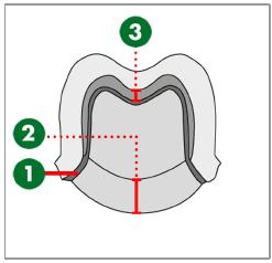 11.3 Pokyny pro nastavení parametrů Následující informace vám pomohou nastavit parametry pahýlů pro Straumann CARES Visual 8.0 software.