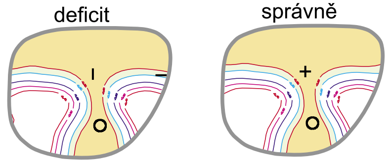 Pokud klienta hypermetropa sféricky podkorigujeme (myopa překorigujeme), vznikne kladný refrakční deficit.