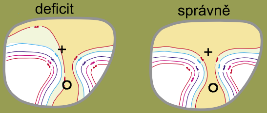 Obrázek 62: Obrázek vlevo znázorňuje vidění s čočkou se špatně provedenou korekcí astigmatismu (34) Další případ je podobný, s tím rozdílem že tady jde o astigmatismus šikmých os: předpis: +0,50 Add