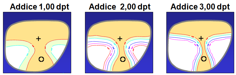 Deficit způsobený pouze odchylkou osy cylindru při vyšší hodnotě cylindru může způsobit, že čočka je nepoužitelná pro nošení (Obrázek 64).