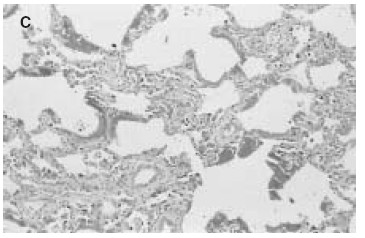 Časné komplikace po transplantaci plic Reperfúzní plicní edém Primární dysfunkce štěpu Lick SD, Brown PS, Kurusz