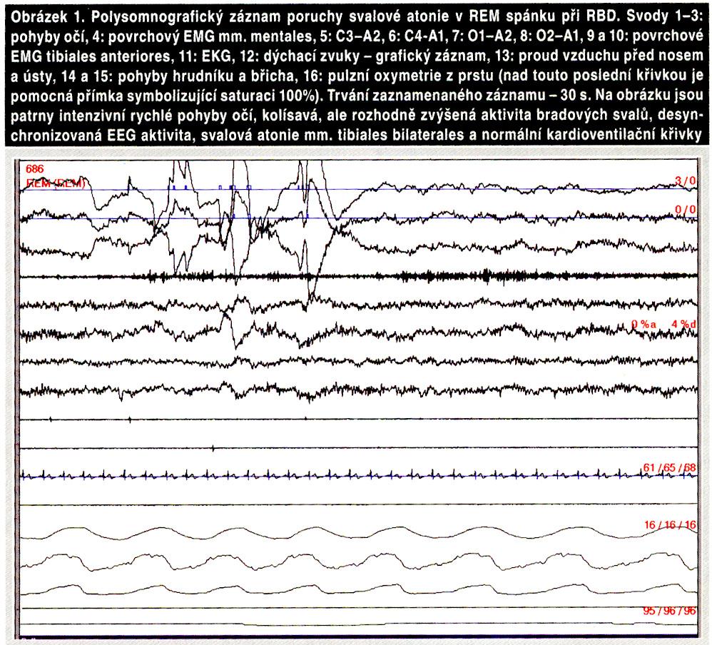 RBD 1/3 pacientů s PN