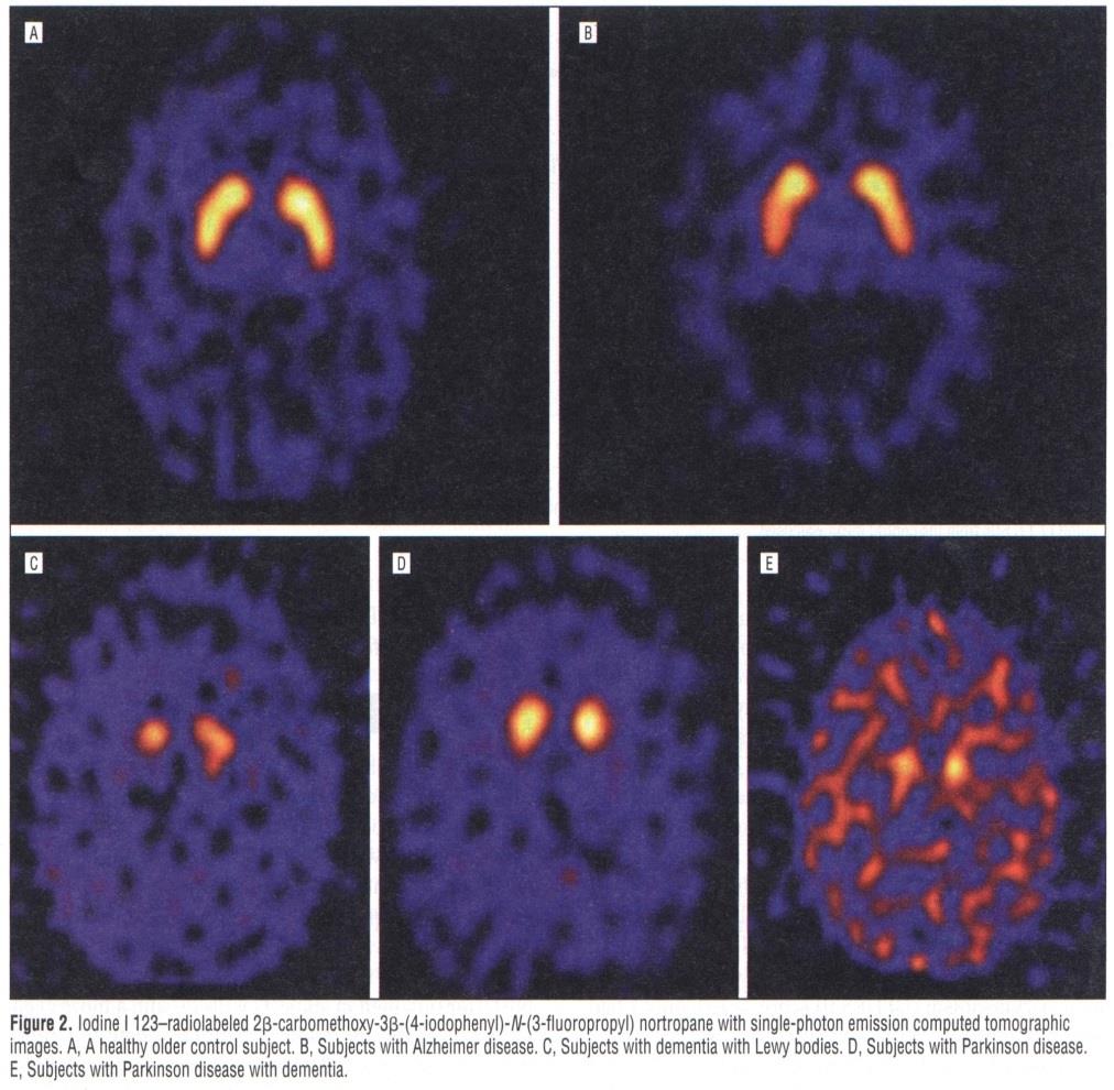 FP-CIT SPECT (DAT scan): odliší DLB x AD McKeith et al, Lancet Neurol 2007 Senzitivita 77,7% pro detekci klinicky