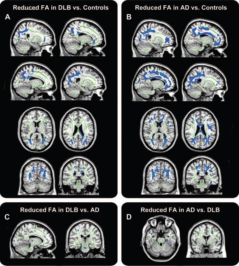 DTI MRI u DLB (vs.