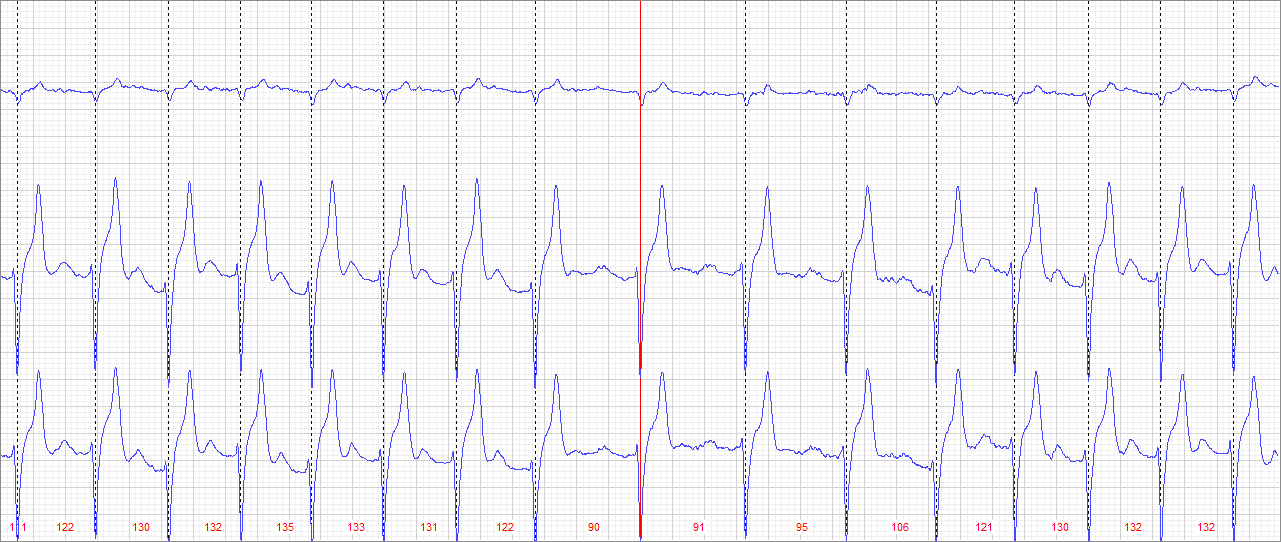 Sinusová arytmie V důsledku zvýšené parasympatikotonie U koní v klidu méně častá Vyskytuje se