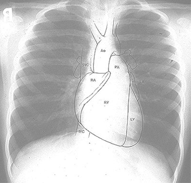 RTG SRDCE A PLIC Velikost srdce: Kardiomegalie: srdeční selhání, dilatace RA: PA/IVS, EBST Tvar srdečního stínu: Dřevákovitý: TOF Vejčitý s úzkou cévní stopkou: