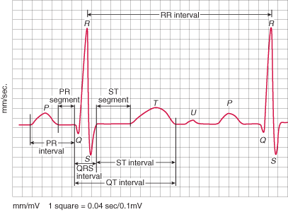 EKG Novorozenec = převaha RV AQRS +90 +180 hypertrofie RV Vady s malou RV posun AQRS doleva (PA/IVS +30 +90, TA -30-90 ) zvětšení RA: