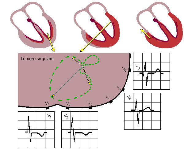 Hypertrofie pravé komory RIGHT VENTRICULAR HYPERTROPHY Large