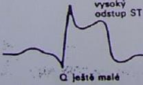 Infarkt myokardu 1. Akutní stadium (po hodinách) 2.